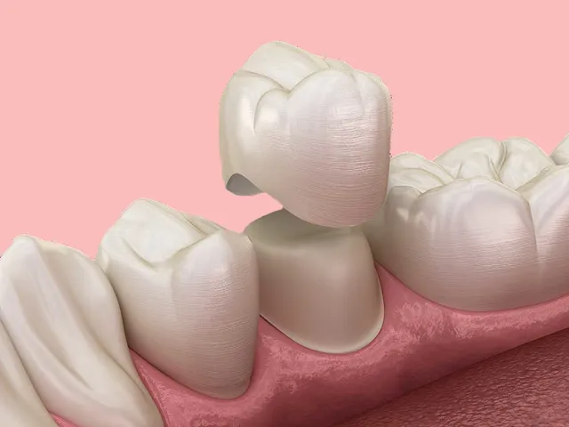 Diagram of a dental crown being placed on a tooth