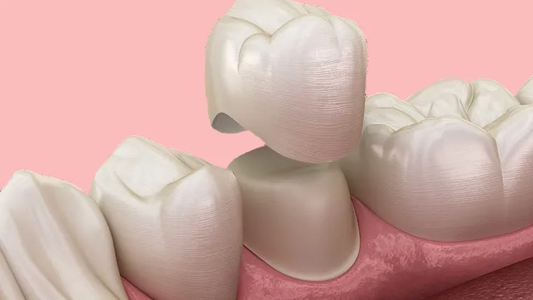 Diagram of a dental crown being placed on a tooth