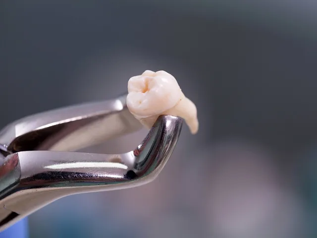 A tooth held by a dental extraction tool