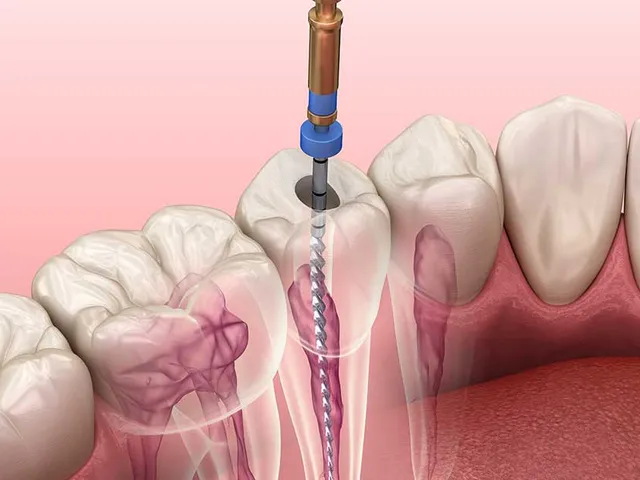 Diagram of an endodontic root canal procedure