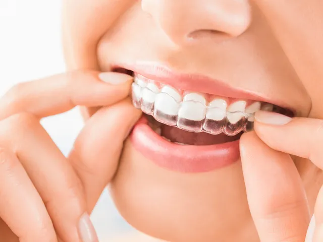 A patient placing a clear Invisalign aligner over her teeth