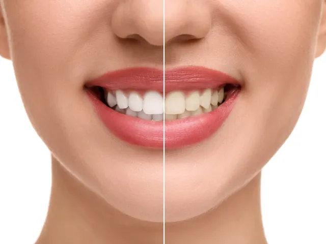 A bright, professionally whitened smile