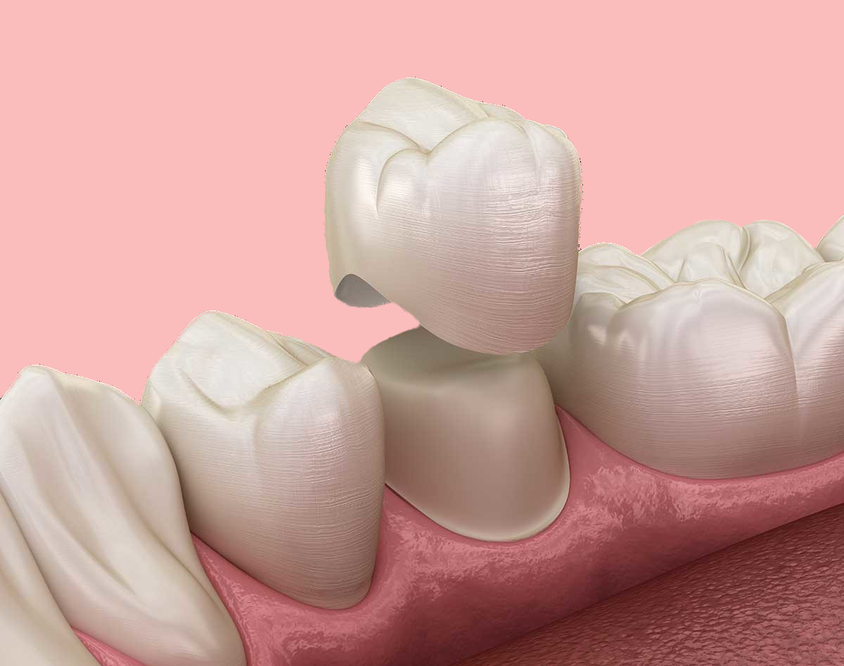 Diagram image of a dental crown being placed on a tooth.